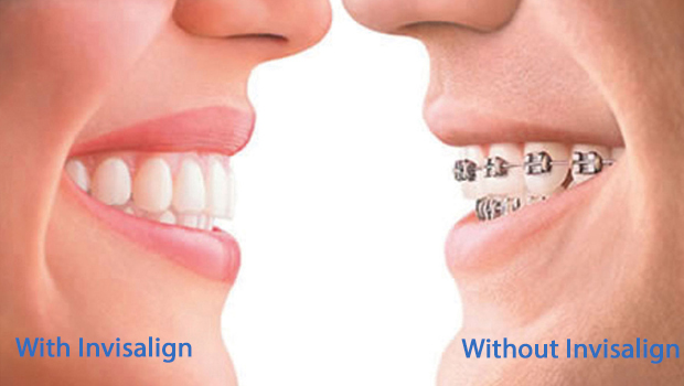 Mooresville Invisalign