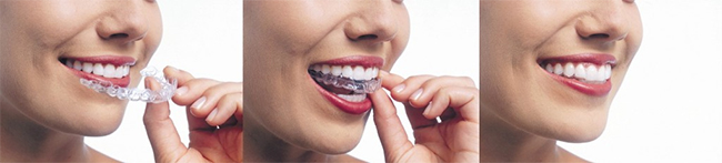 Invisalign near The Pointe